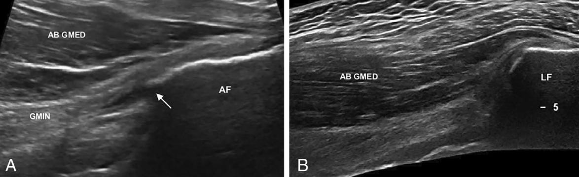 Gluteo menor 3 ecografia tempo formacion.jpg